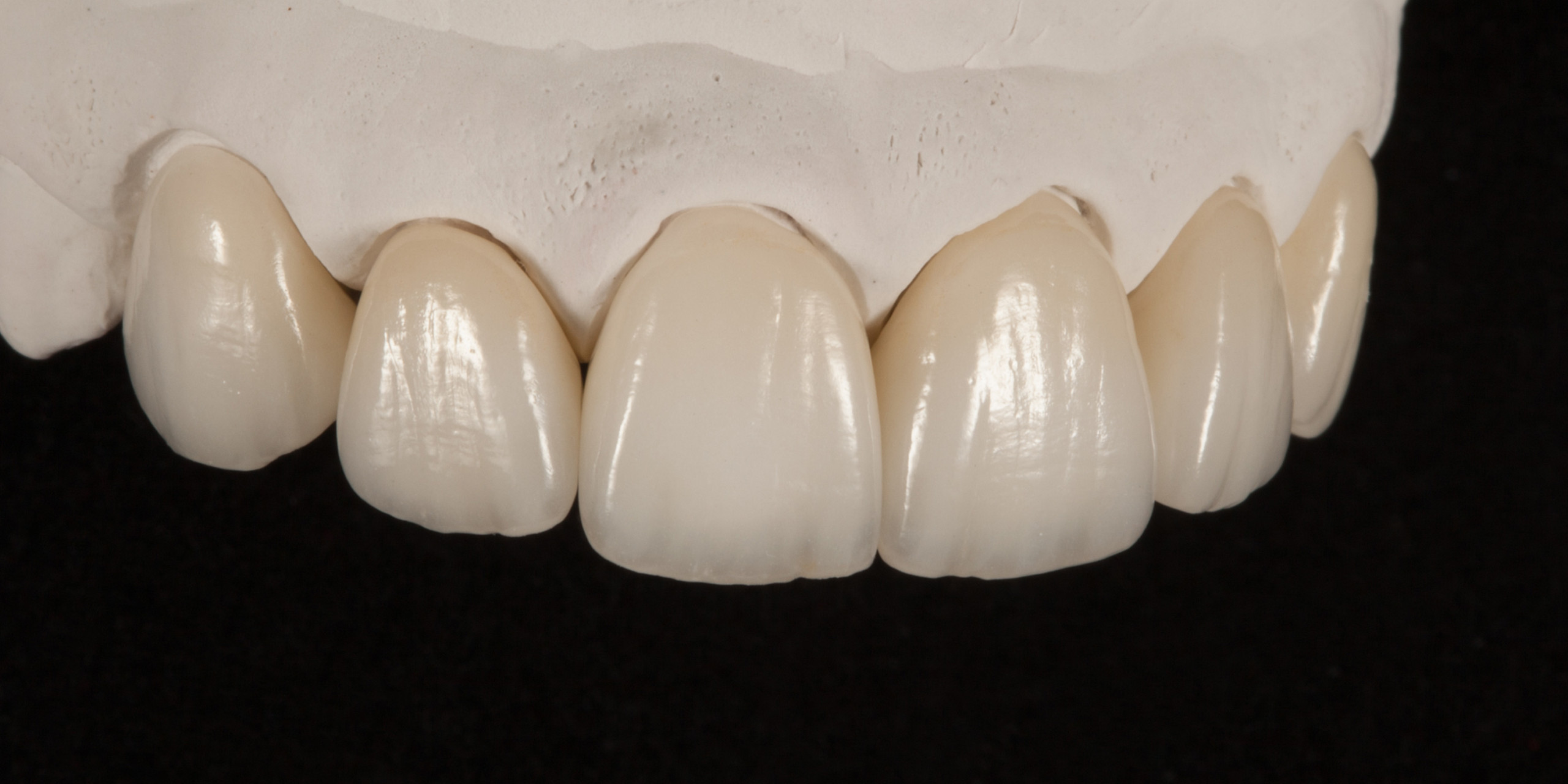 Dentallabor Daniel Lange - Ästhetische Korrektur und Lückenschluss mit Veneers