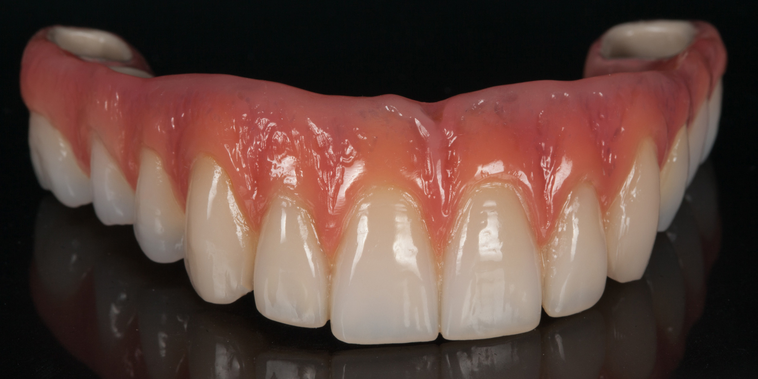 Dentallabor Daniel Lange - Implantatgetragene Brücke im zahnlosen Kiefer