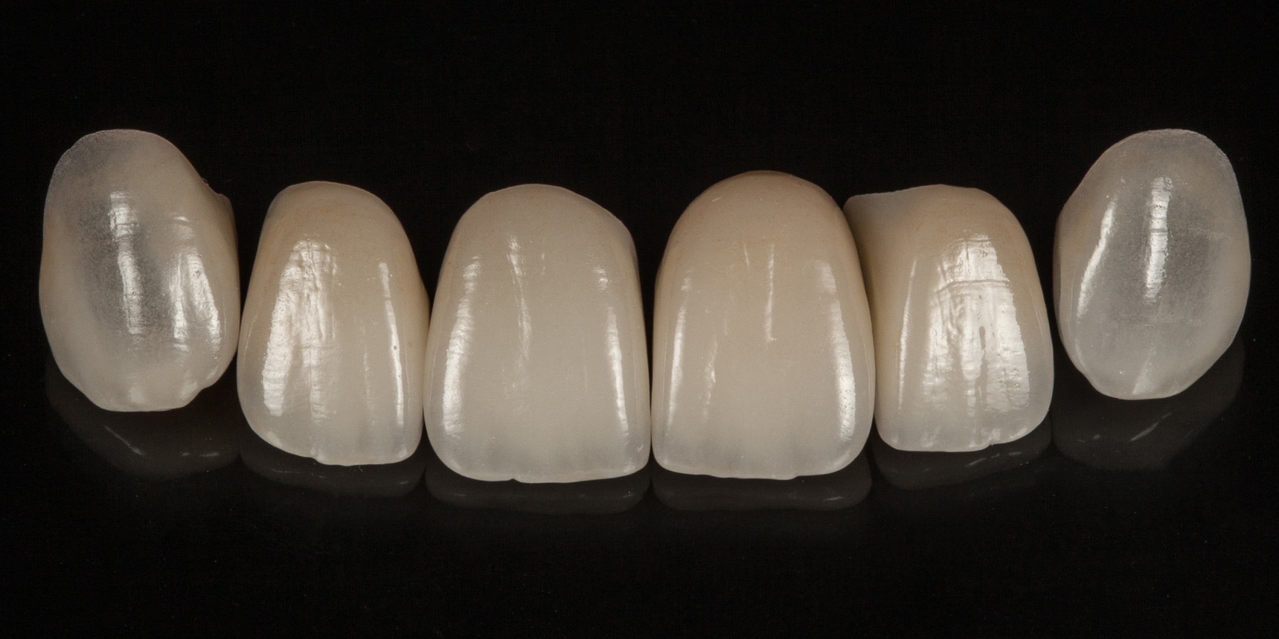 Dentallabor Daniel Lange - Implantatversorgung im Frontzahnbereich