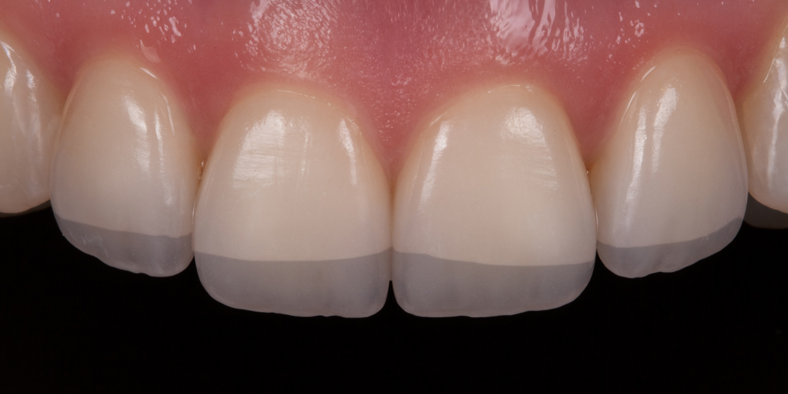 Dentallabor Daniel Lange - Individuell geschichtete Veneers