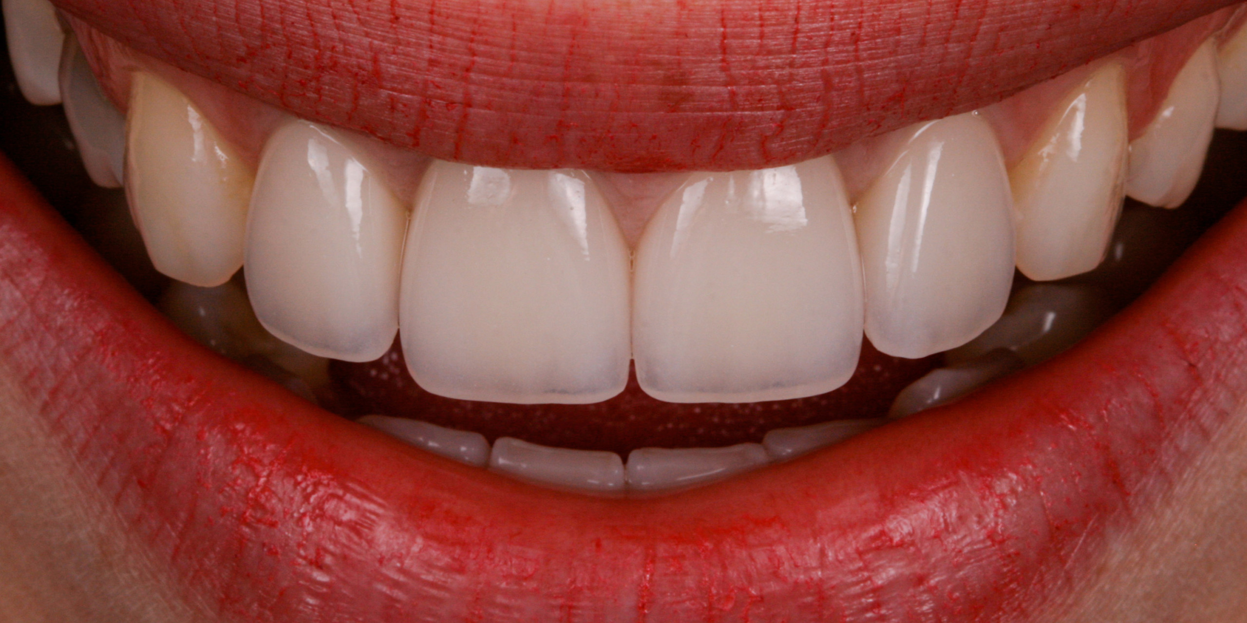 Dentallabor Daniel Lange - Individuell geschichtete Vollkeramikkronen